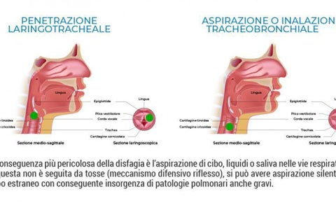 Le principali cause di disfagia