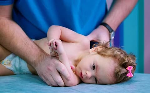 CASE REPORT - Valutazione della disfagia nella paralisi cerebrale infantile